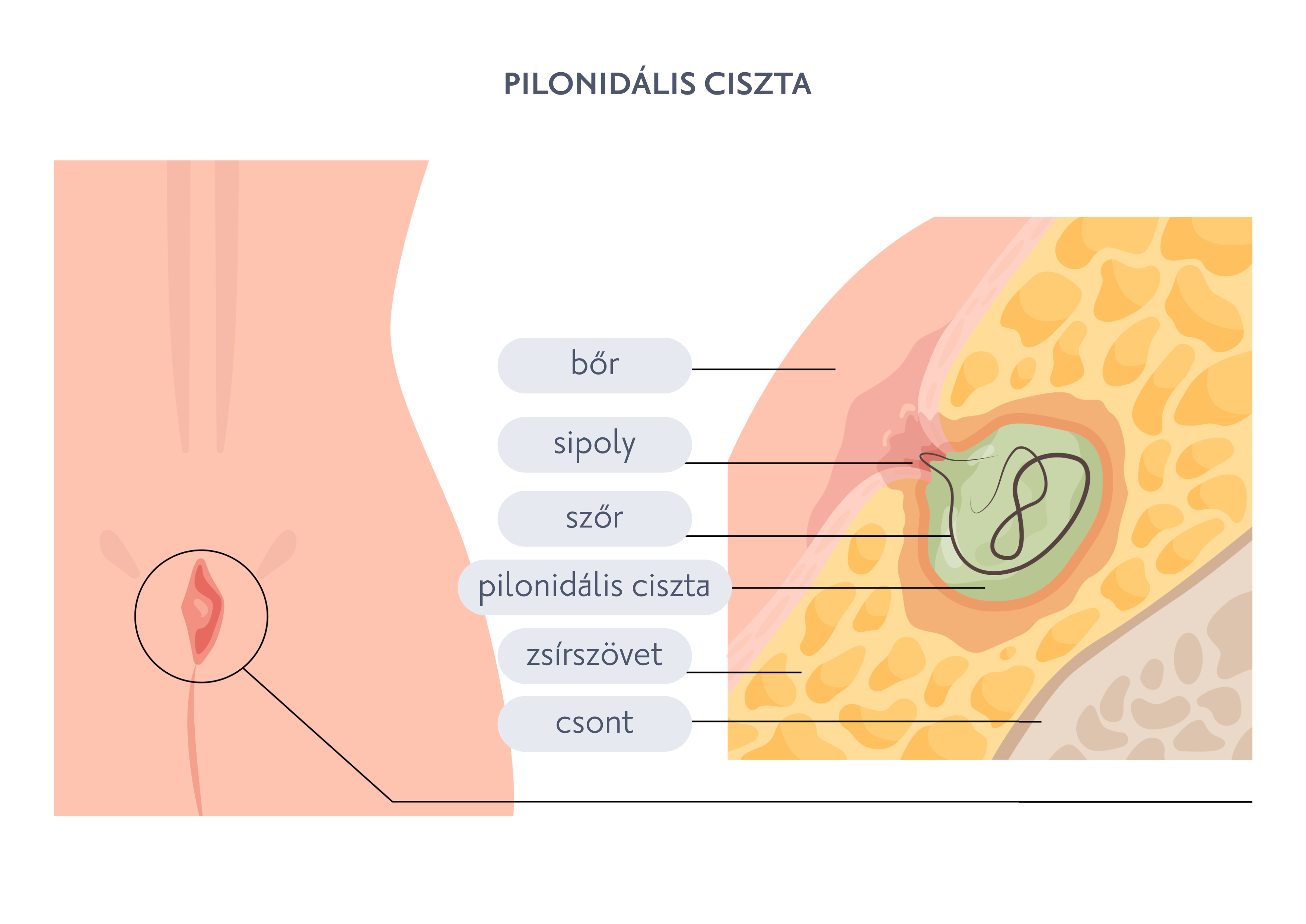Pilonidális ciszta