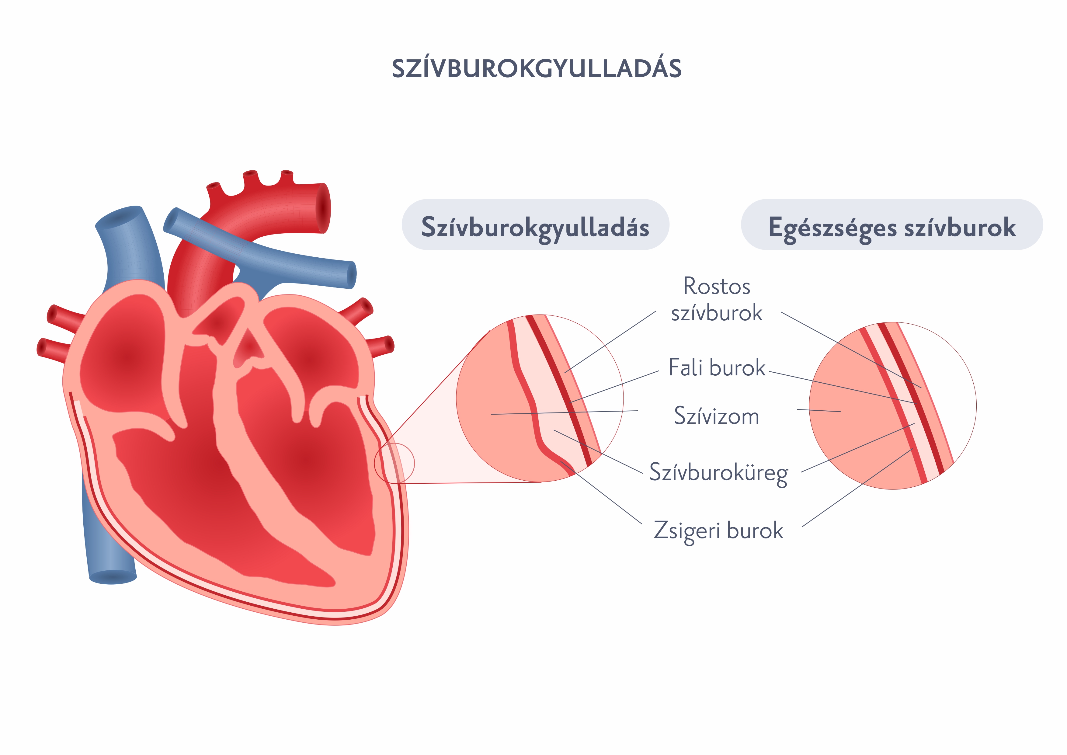 Szívburokgyulladás (pericarditis)