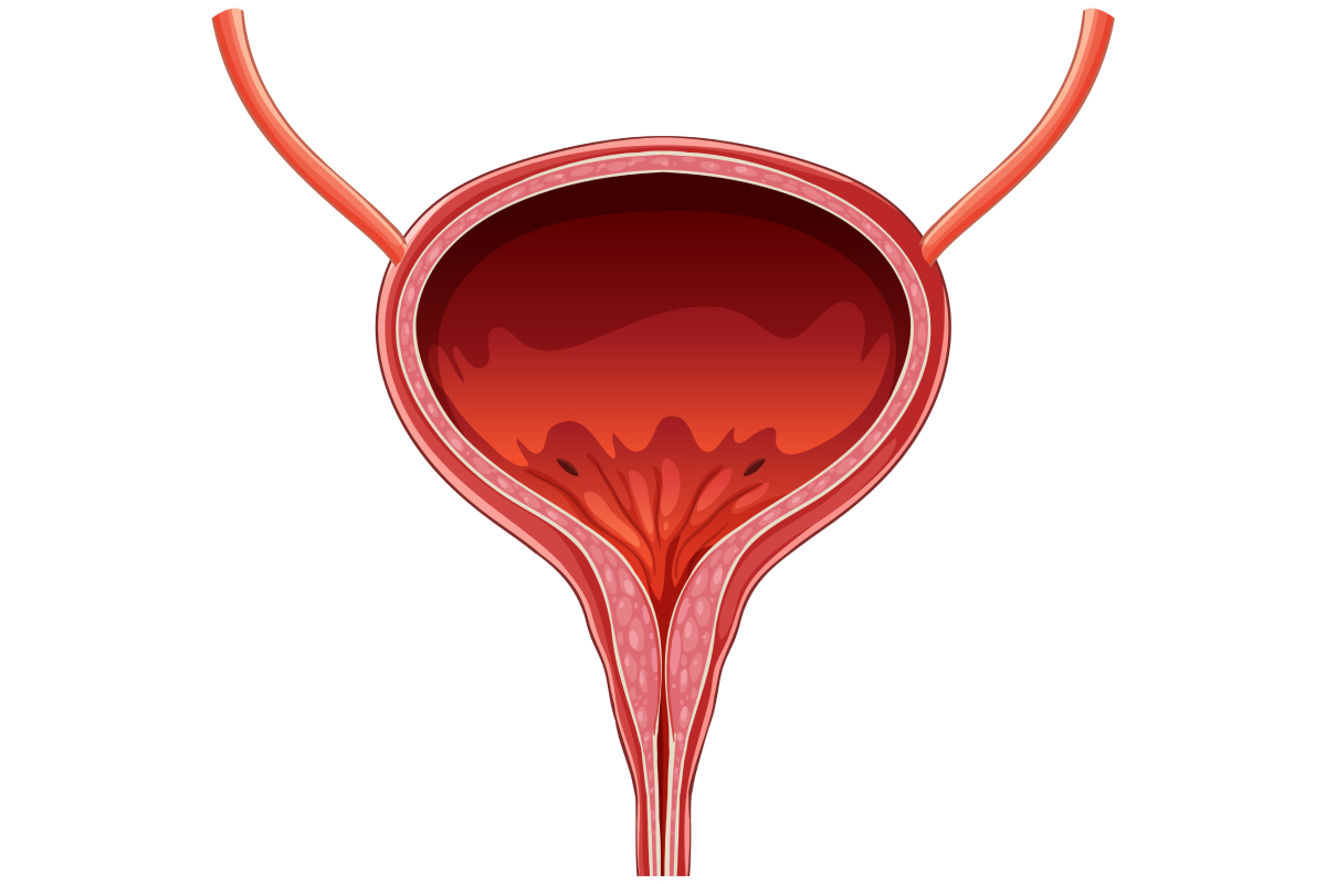 Hólyagfájdalom szindróma (interstitialis cystitis)