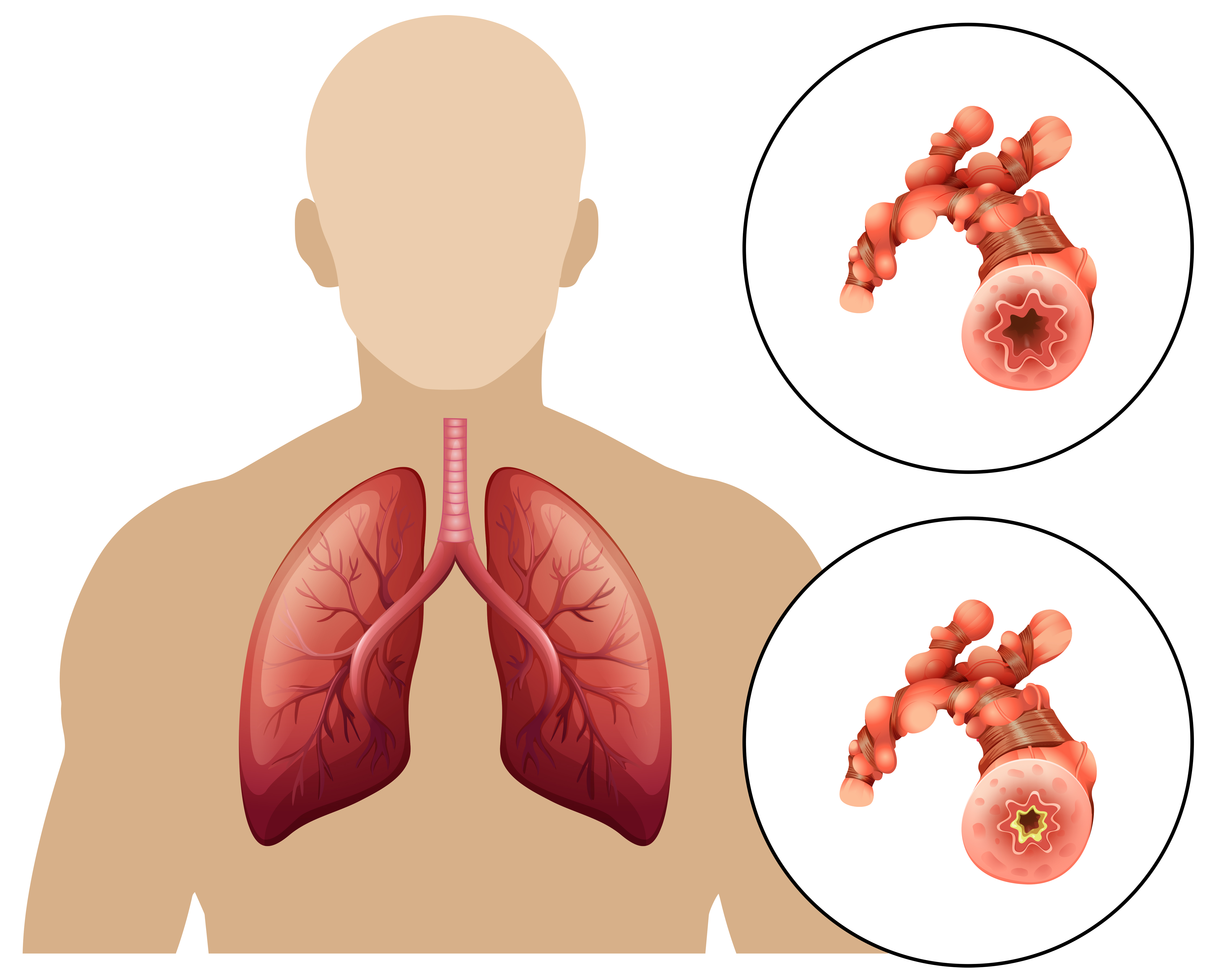 Bronchitis: ezek az árulkodó tünetek - EgészségKalauz