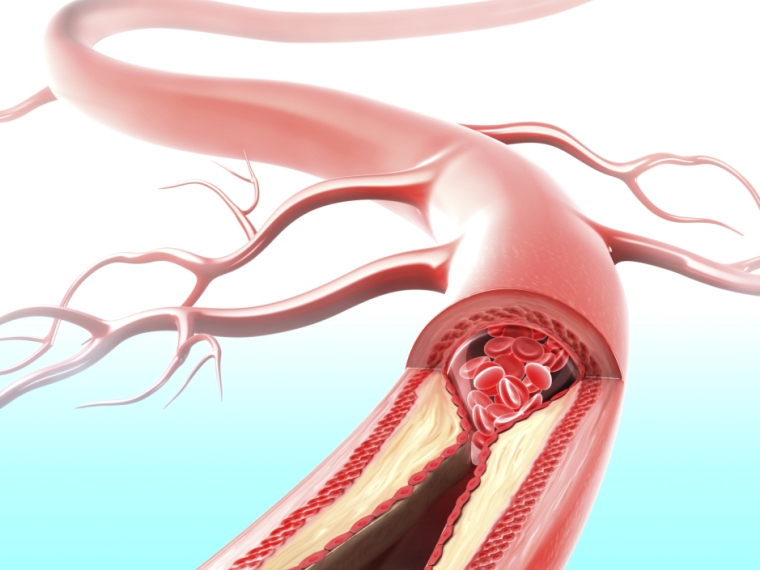 portális véna thrombosis fogyás