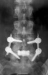 Gerinccsigolya rögzítés röntgen