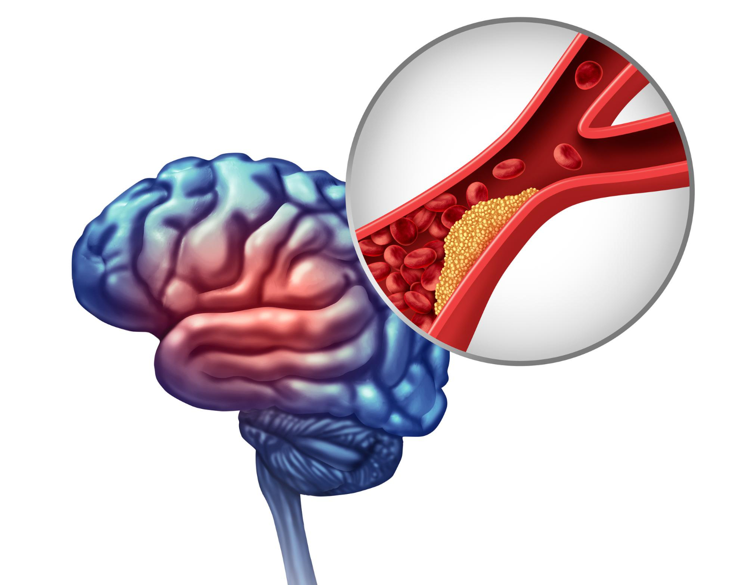 Kardiológiai problémák időskorban I. – érelmeszesedés, infarktus, stroke