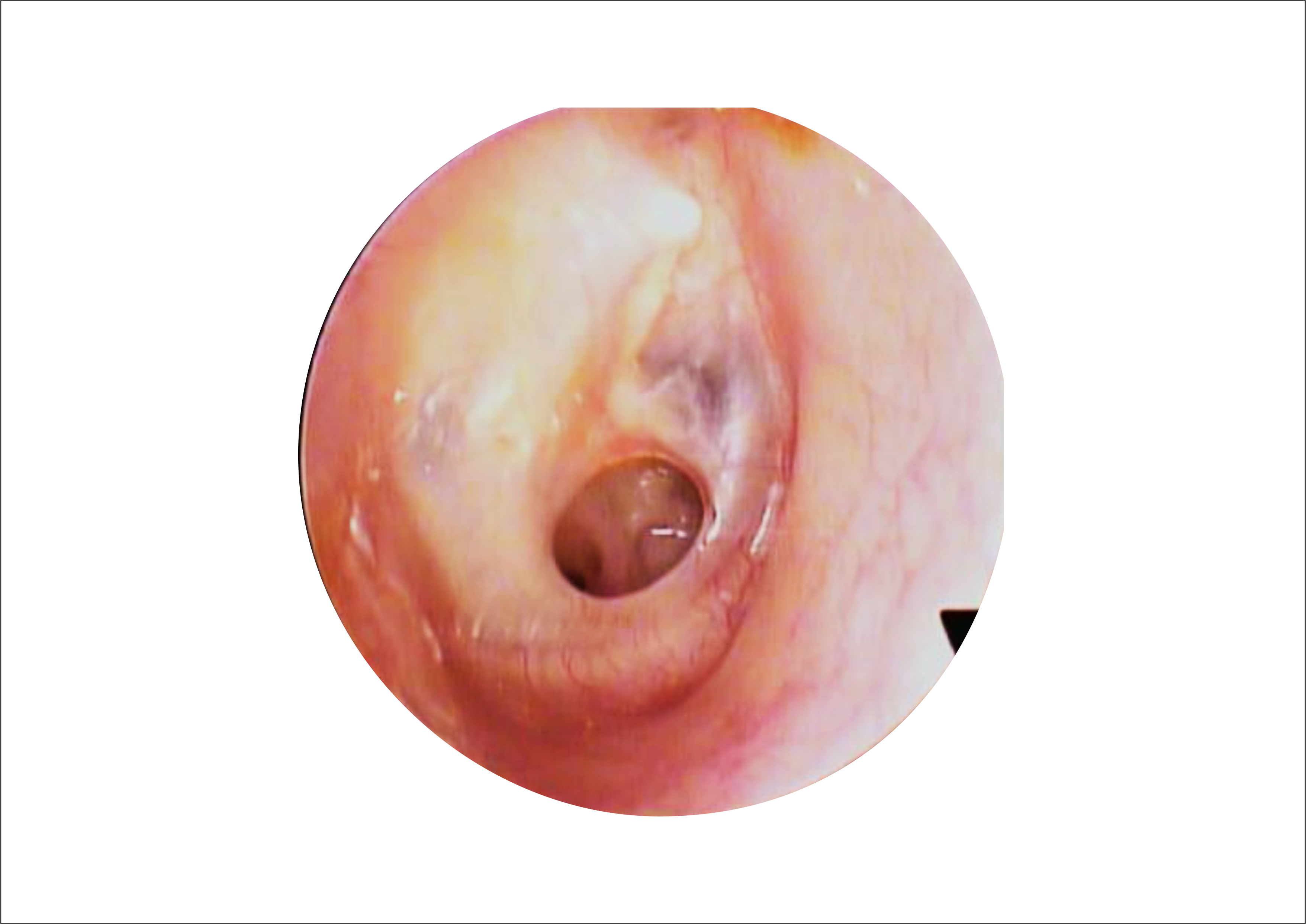 Cholestesteatoma endoszkópos képe