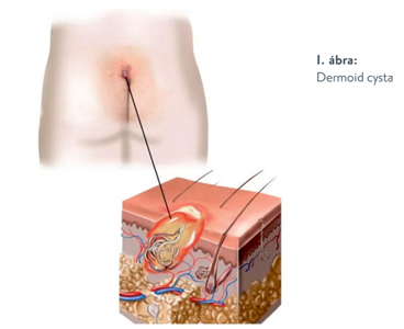 Dermoid ciszta - Kiemelt kezelő