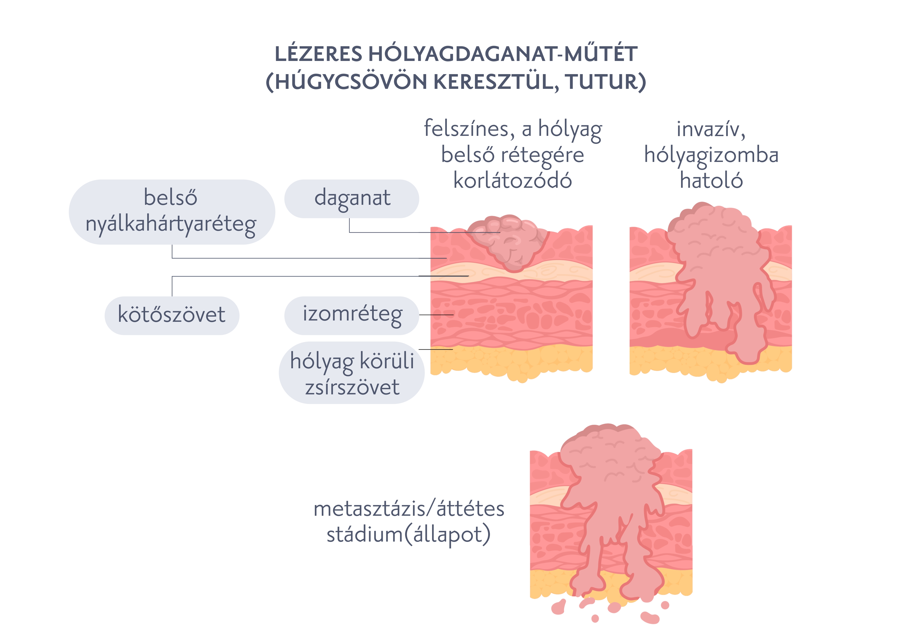 Lézeres hólyagdaganat-műtét (húgycsövön keresztül, TUTUR)