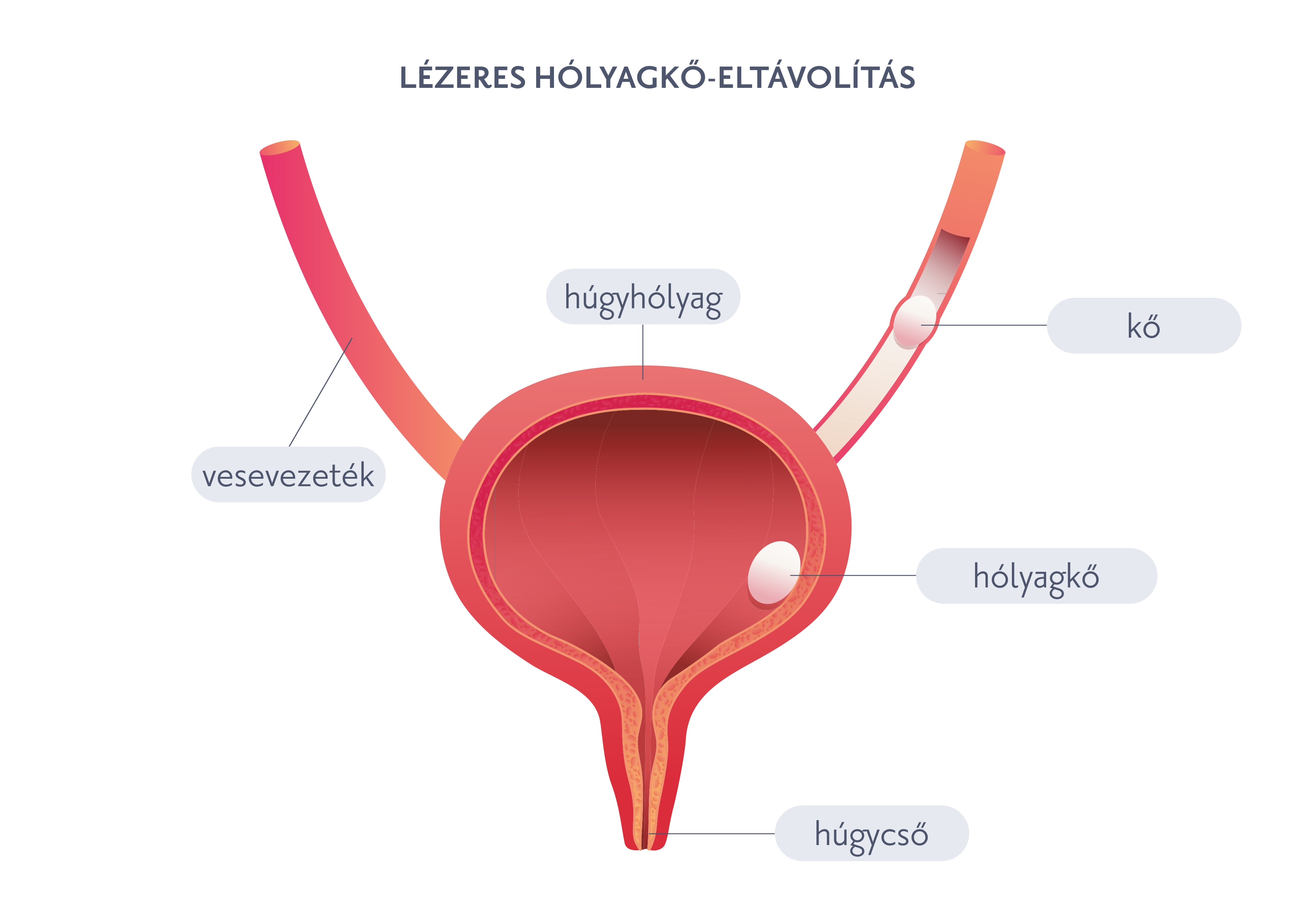 Lézeres hólyagkő-eltávolítás