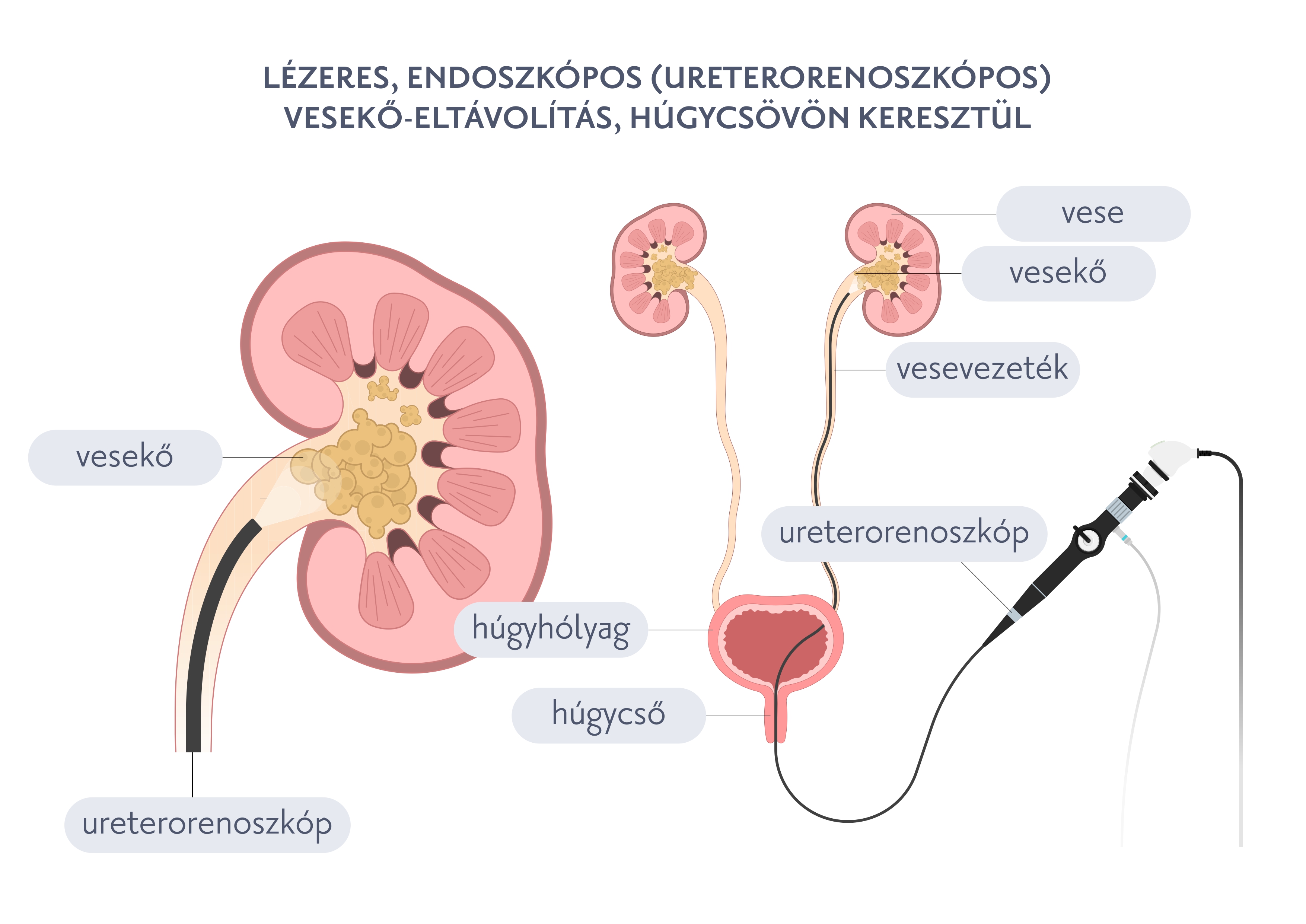 Lézeres, endoszkópos (ureterorenoszkópos) vesekő-eltávolítás, húgycsövön keresztül