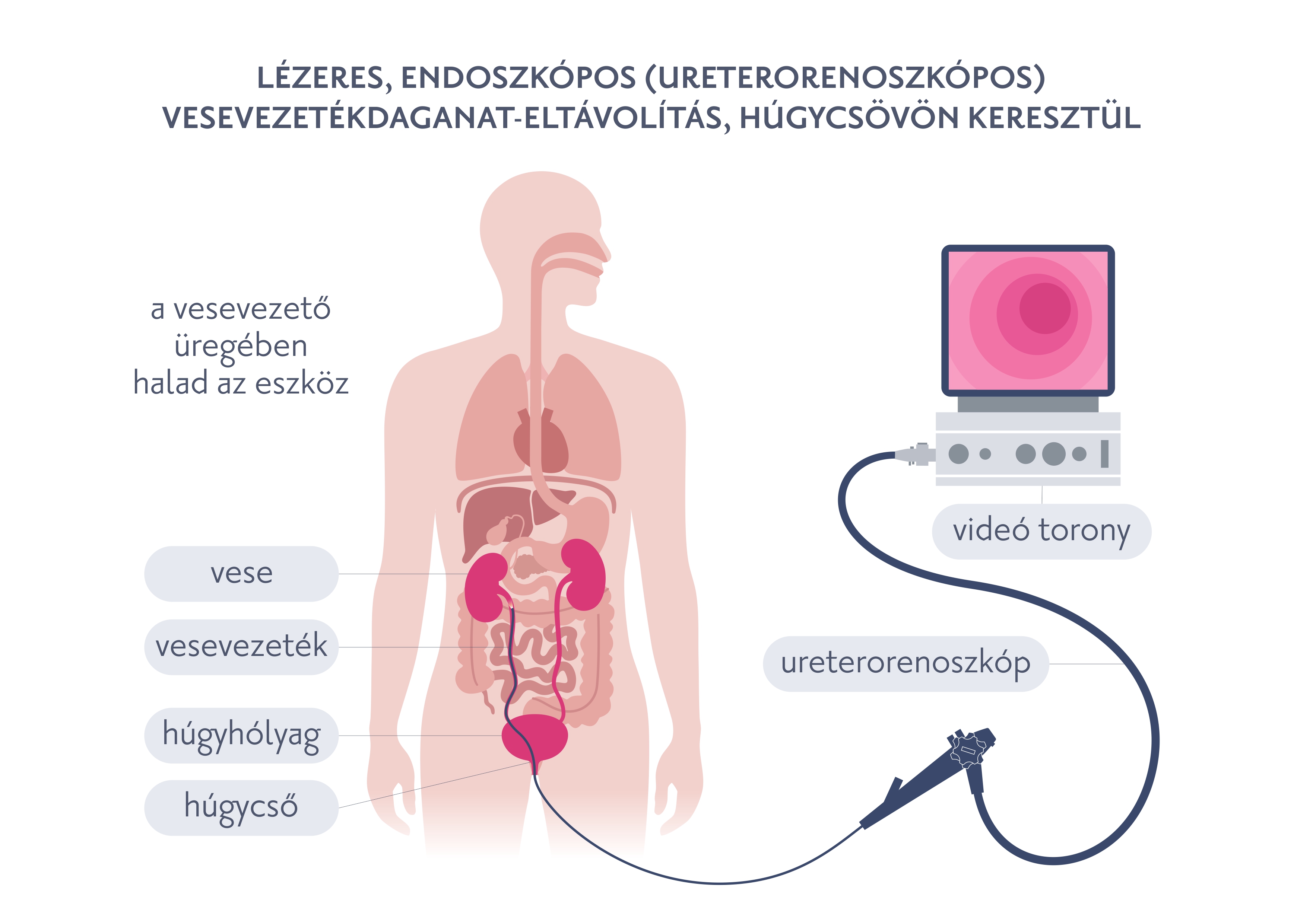 Lézeres, endoszkópos (ureterorenoszkópos) vesevezetékdaganat-eltávolítás, húgycsövön keresztül