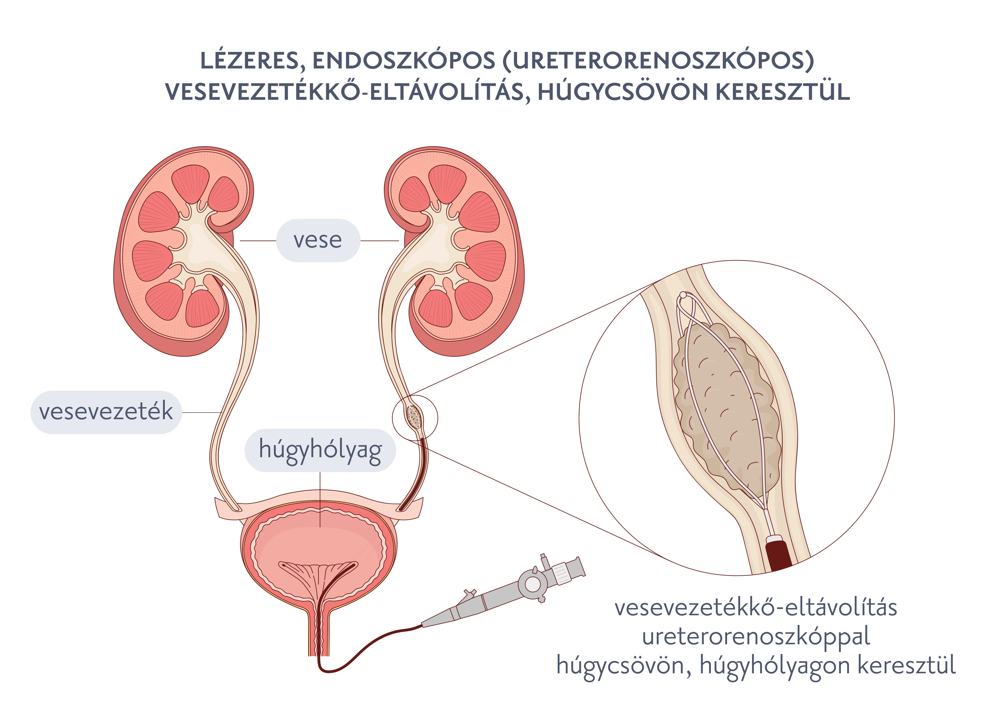 Lézeres, endoszkópos (ureterorenoszkópos) vesevezetékkő-eltávolítás, húgycsövön keresztül