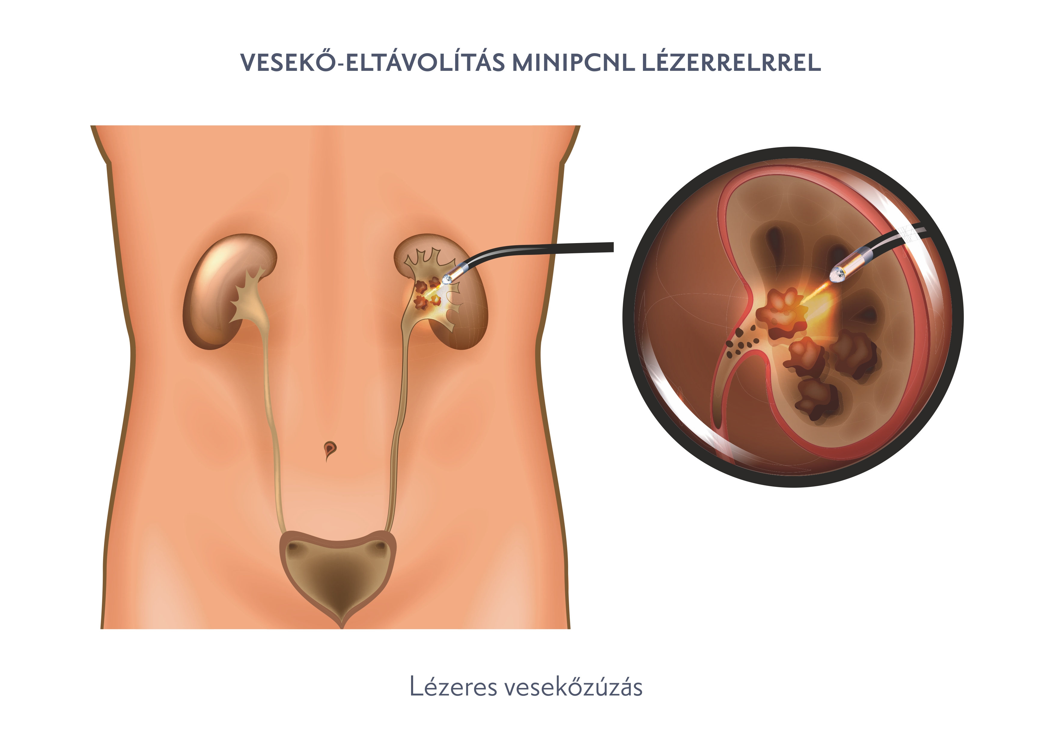 Vesekő-eltávolítás MiniPCNL lézerrelrrel