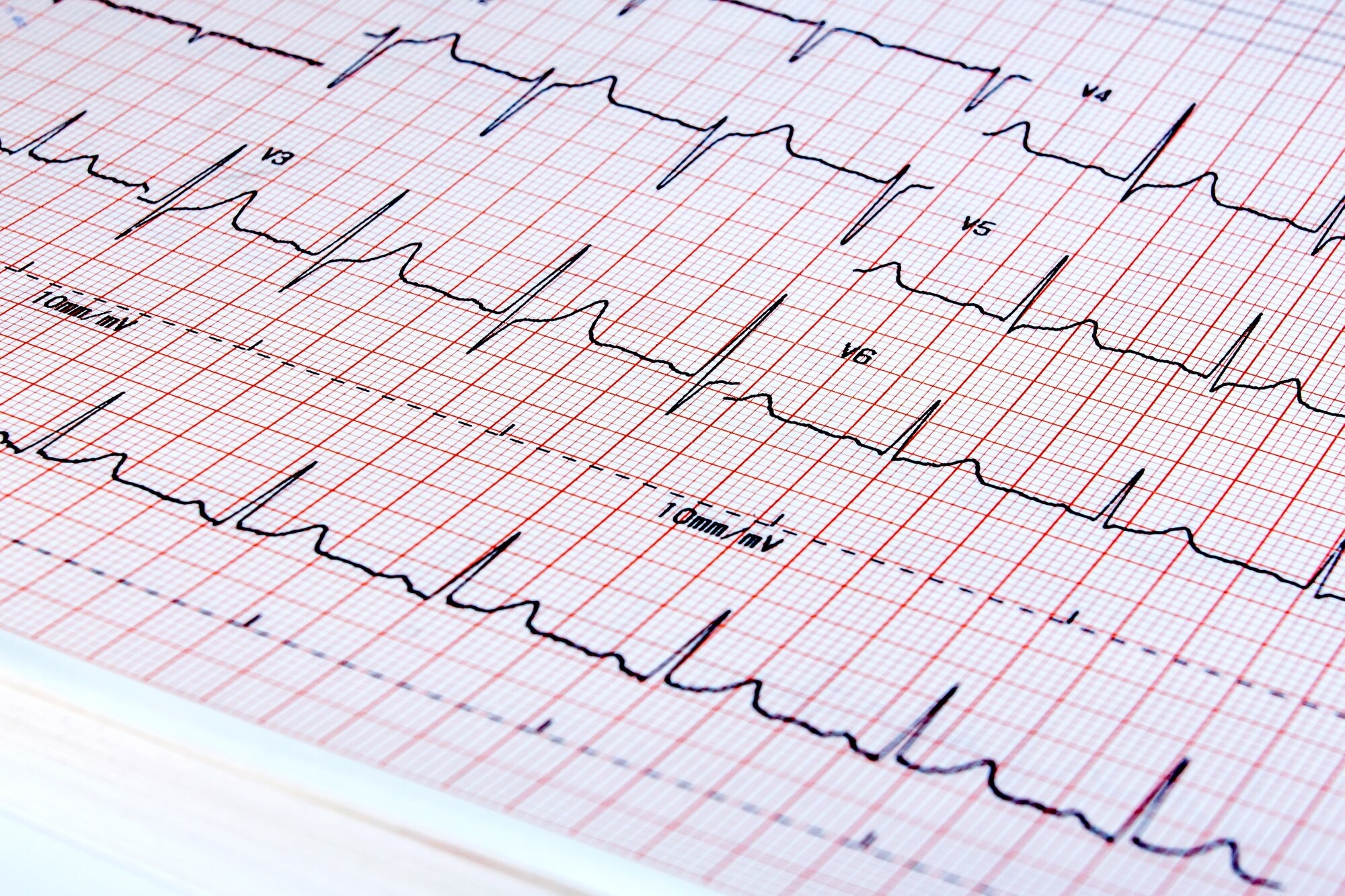 Nyugalmi EKG