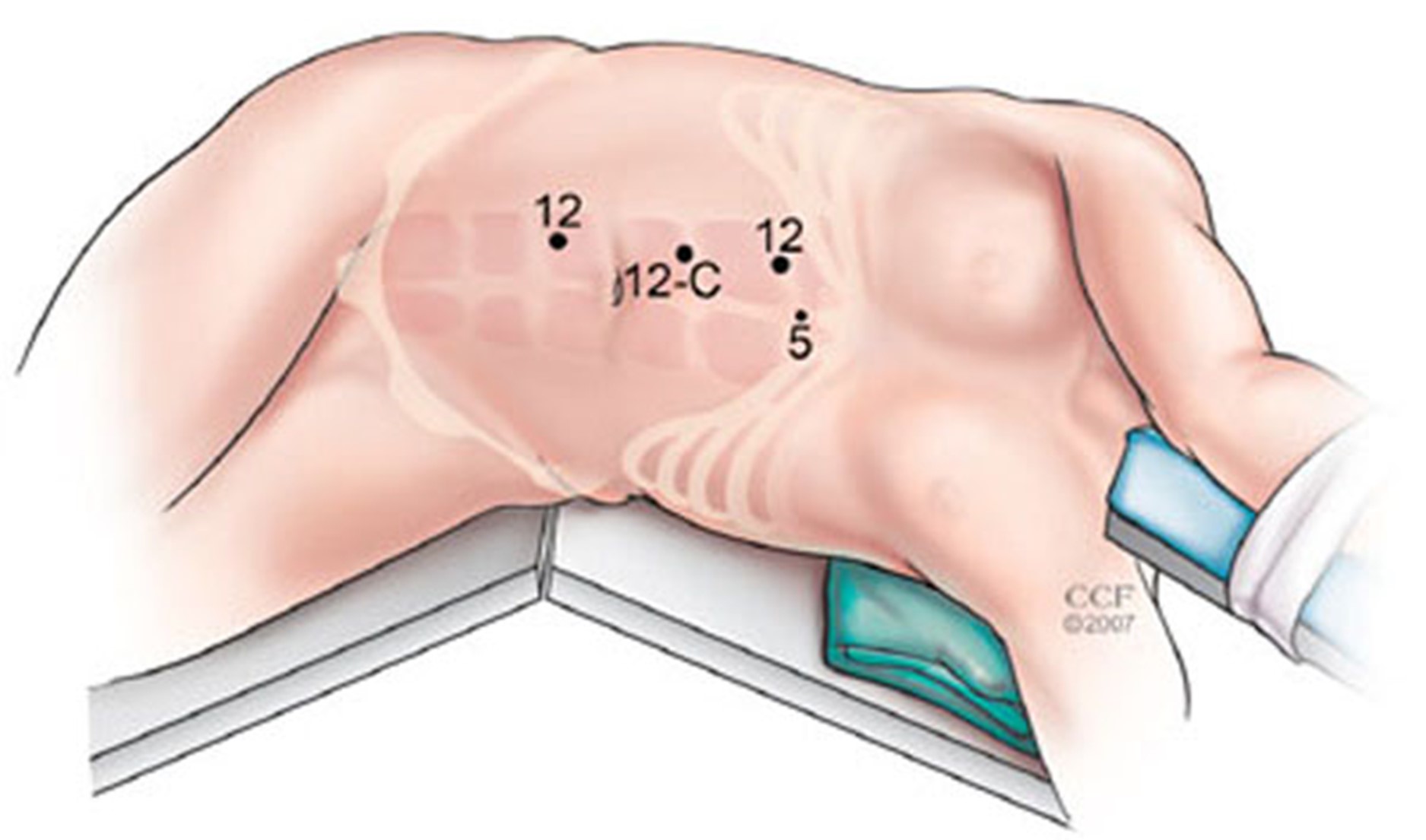 Laparoszkópos vese-vesevezető eltávolítás (nephroureterectomia) hólyagmandzsetta képzéssel