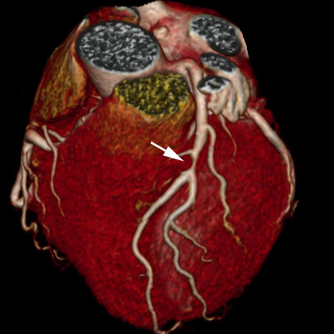 szív- és nyaki erek állapotának felmérése Detralex és magas vérnyomás