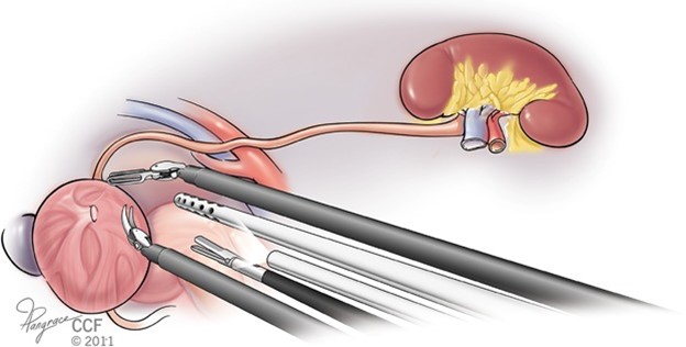 Laparoszkópos vese-vesevezető eltávolítás