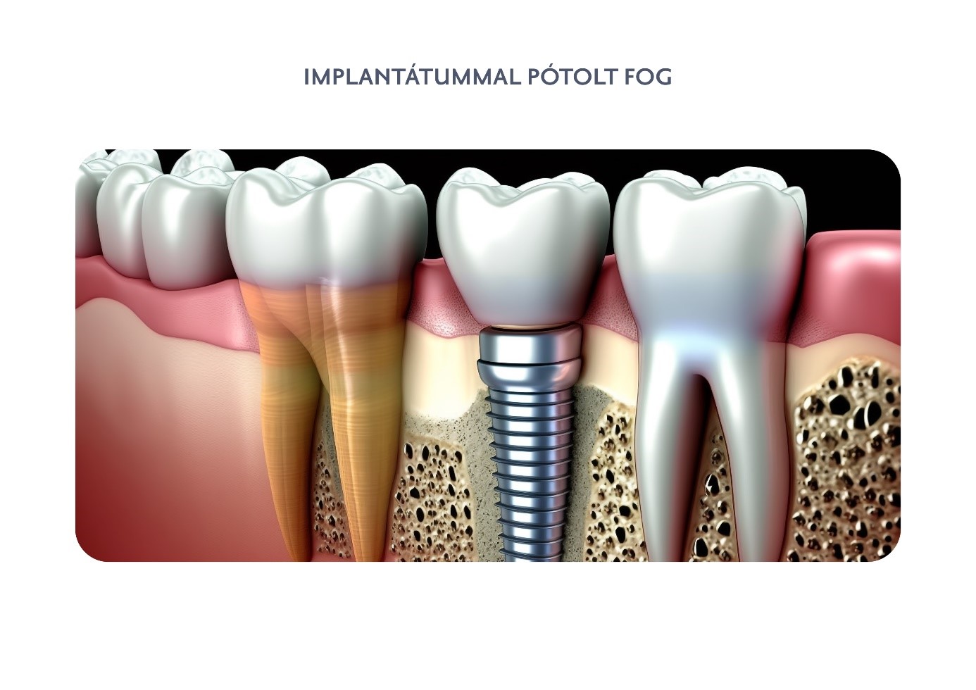 Implantátummal pótolt fog - Budai Egészségközpont