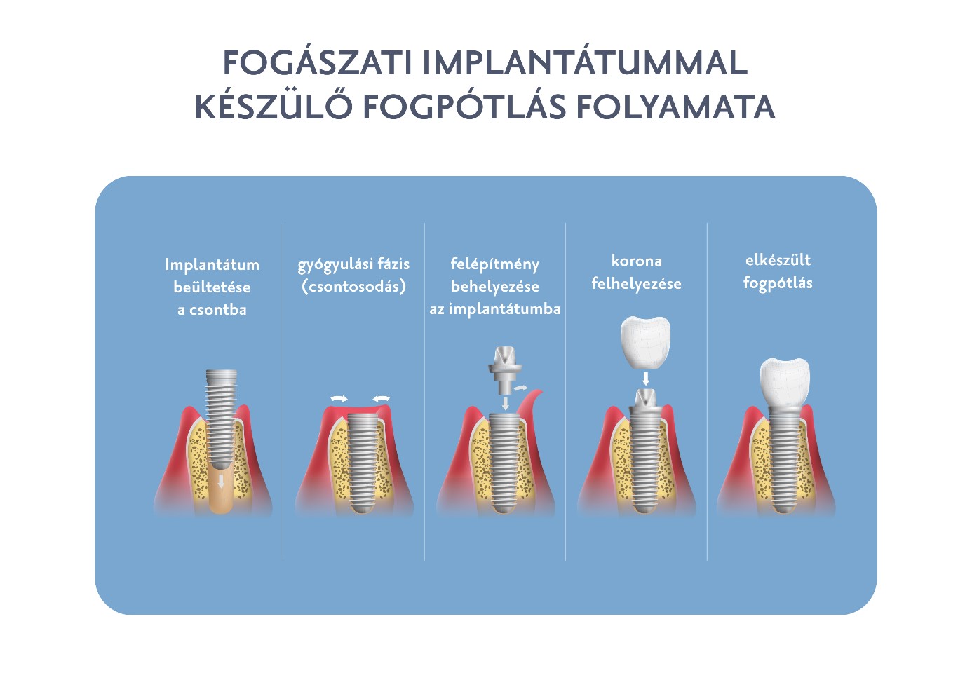 Fogászati implantátummal készülő fogpótlás folyamata - Budai Egészségközpont