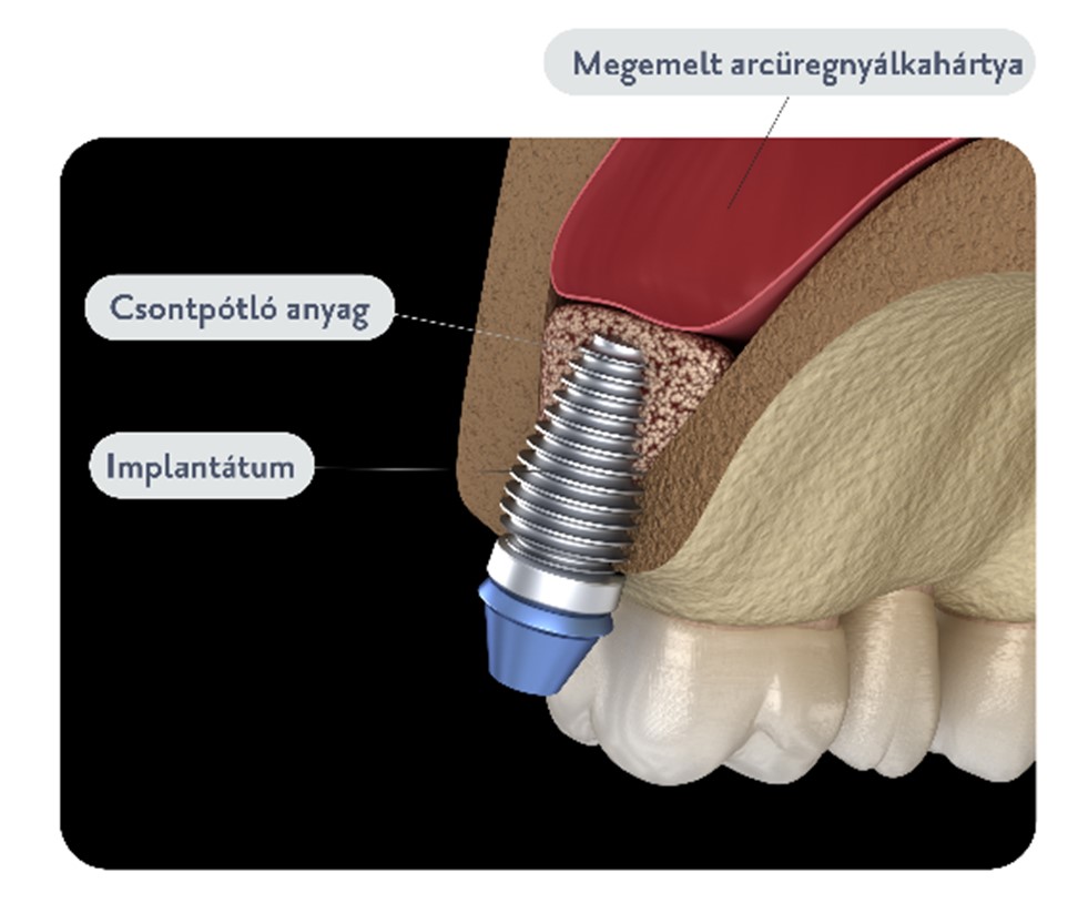 Csontpótlás - Budai Egészségközpont