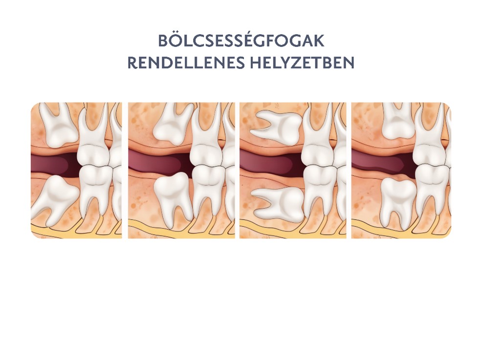 Bölcsességfogak rendellenes helyzetben - Budai Egészségközpont