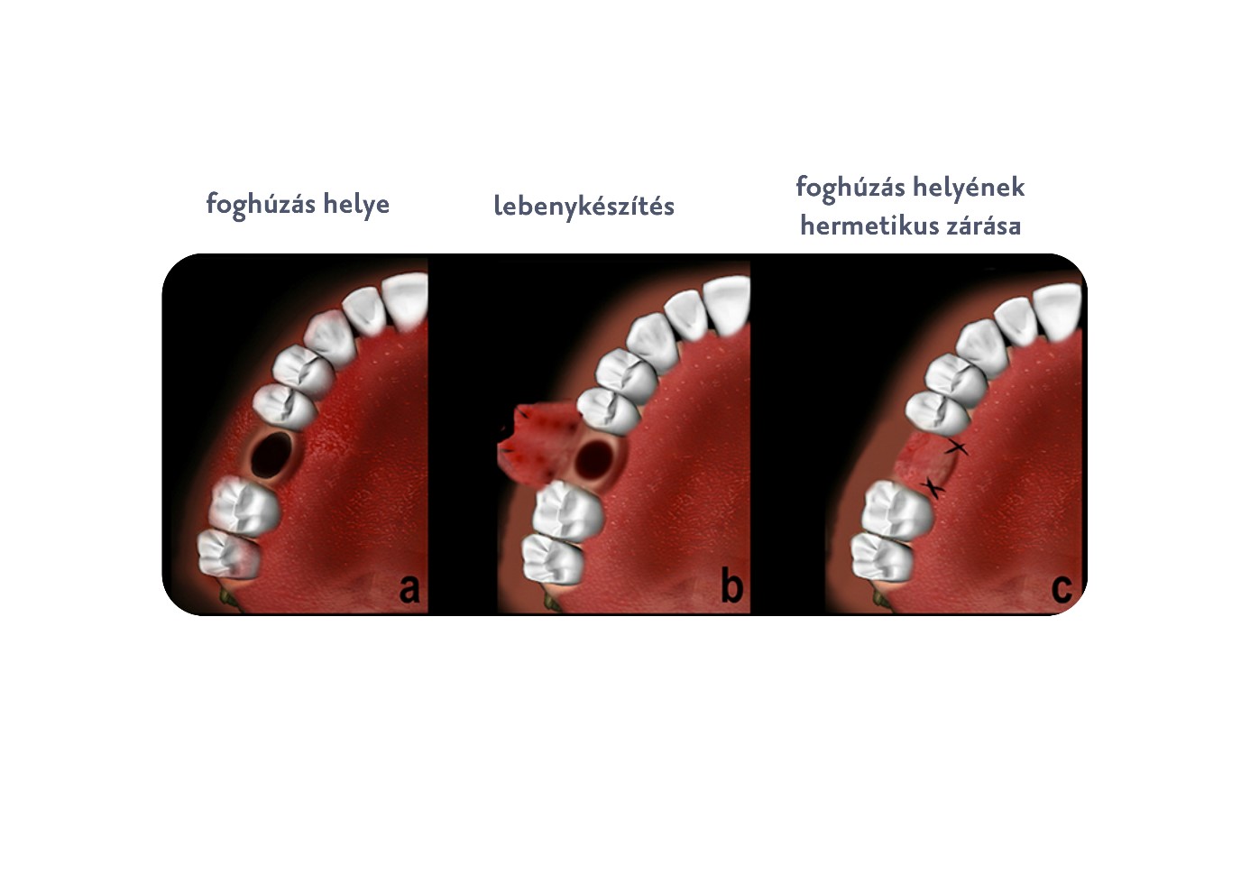 Foghúzás utáni sebészeti eljárás folyamata - Budai Egészségközpont