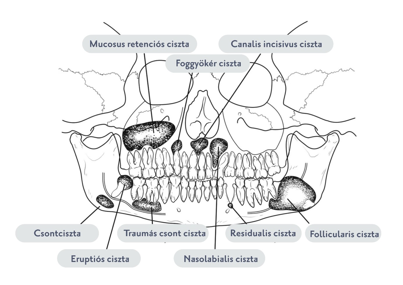 az állcsontokban előforduló ciszták típusai - Budai Egészségközpont