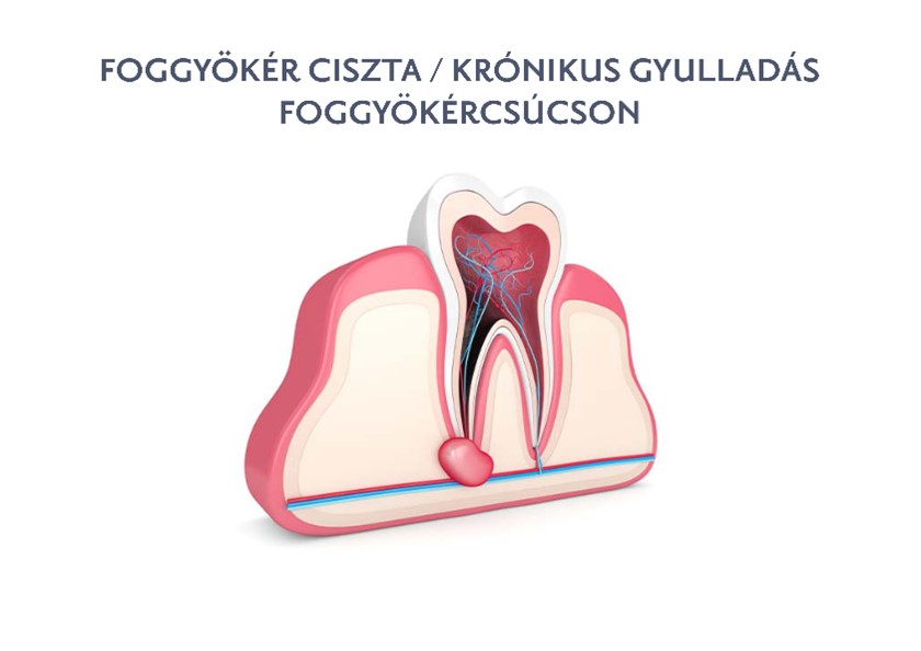 Foggyökér ciszta - Budai Egészségközpont