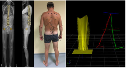 A biomérnökök a projekt keretében különleges szenzorokkal modellezik a gerincbeteg mozgását.