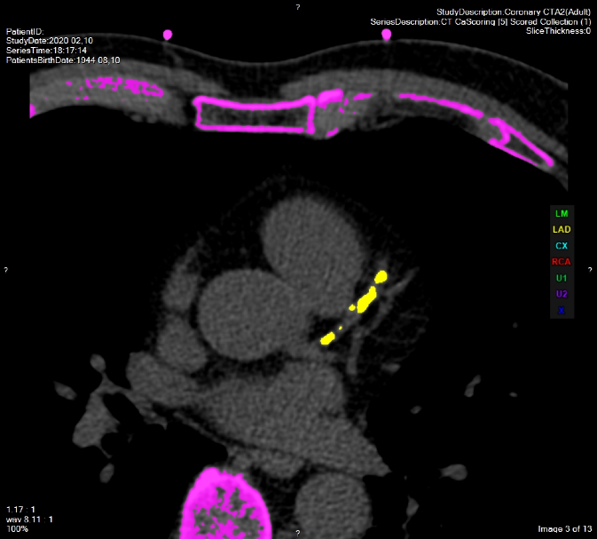 Koszorúereket érintő érelmeszesedés kimutatása coronaria CT vizsgálattal.
