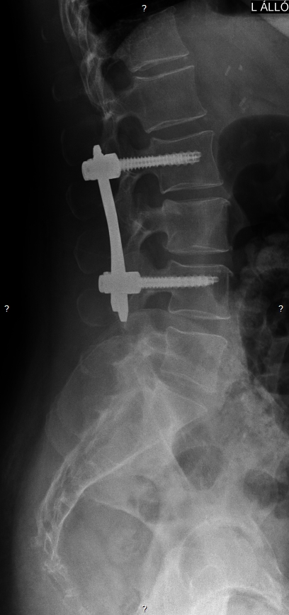 Gerincben található csavar röntgen képen.